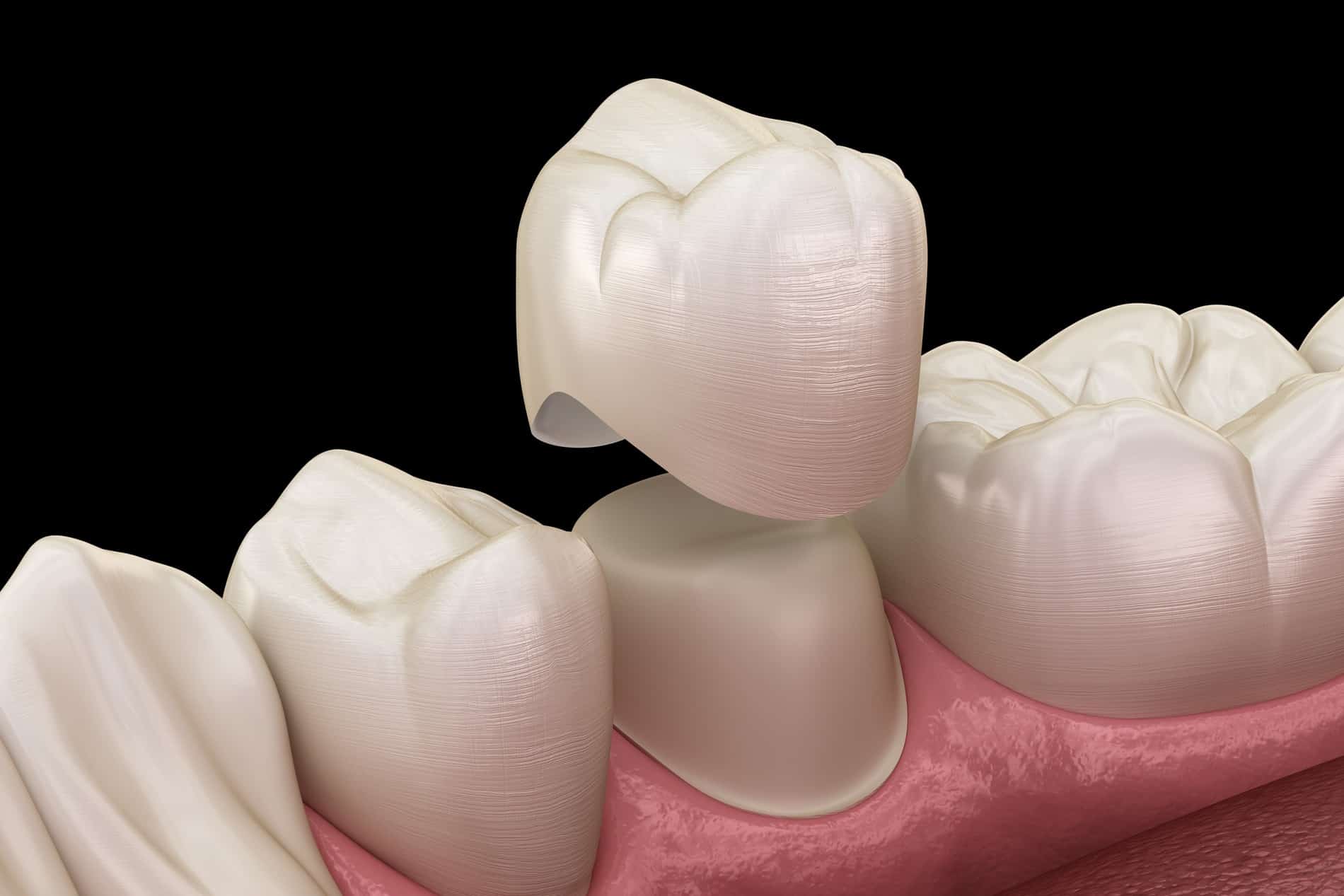 Dental Crown at Prosper Dental Studio in Cornelius NC